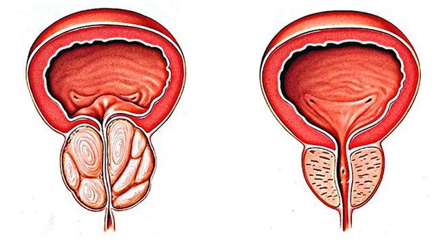 próstata saudável e doente